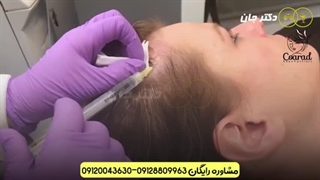 مزوتراپی و پی آرپی برزیلی متد روز اروپا در کلینیک کو آراد