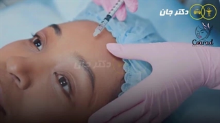 بوتاکس چشم گربه ای کلینیک بین المللی کو آراد