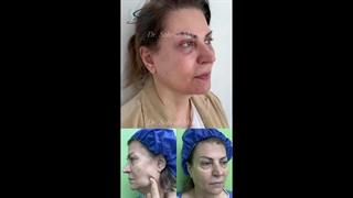 جراحی لیفت عمقی صورت توسط دکتر مرادی اینسایزینگ