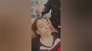 نمونه‌ای از انجام مزونیدلینگ (2)