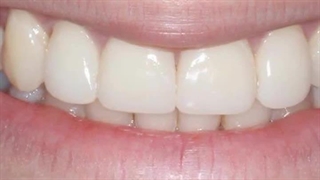 اصلاح طرح لبخند، ارتودنسی و ونیر کامپوزیت