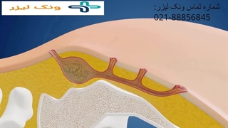 فیلم لیزر کیست مویی