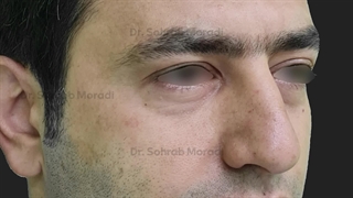 رفع الحاجب بالمنظار للرجال