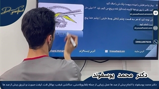 اموزش بلفاروپلاستی مبحث پینچ تست