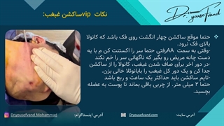 اموزش نکات ویژه ساکشن غبغب