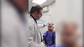 زیبایی طبیعی با خط رویش مو در کاشت مو