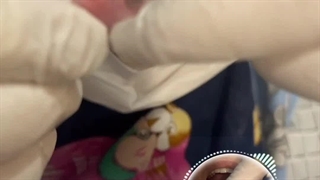 نصب فیلر ژله ای دندان مصنوعی