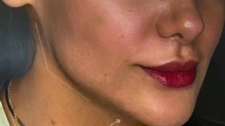 قبل و بعد از اصلاح فرم خط فکی(رفع فرو رفتگی) و زاویه فک با تزریق فیلر