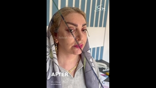 جراحی لیفت صورت و گردن