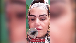 تجربه زیباجو از کاشت ابرو