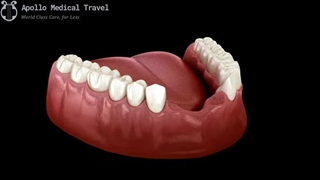 پروتز دندان ثابت