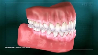 پروتز متحرک دندان