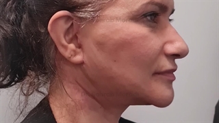 شد الوجه وشد الرقبة