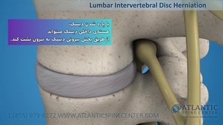 فتق دیسک کمر