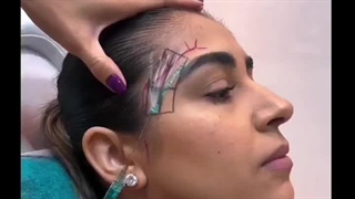 آموزش تخصصی فیلر با تکنیک جدید و ترکیبی