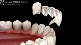 انجام لمینت دندان