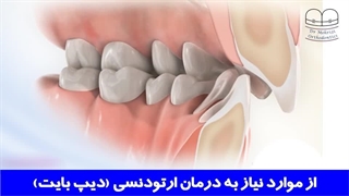 ناهنجاری دیپ بایت