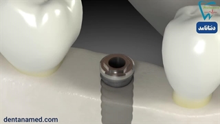 انواع پودر استخوان برای ایمپلنت دندان