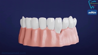 نکات مهم در خرید پودر استخوان برای ایمپلنت