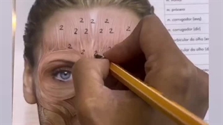 آموزش نقاط تزریق نواحی بوتاکس صورت با تصویر