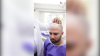 بررسی وضعیت سر قبل از کاشت مو توسط دکتر خراسانی