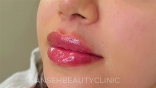 تزریق فیلر لب برای دختر زیبامون