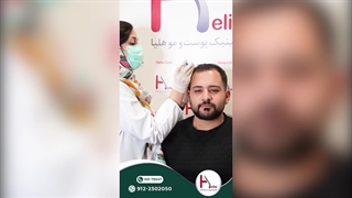 مزوتراپی با کوکتل Revitacare | راهکاری برای رشد مو