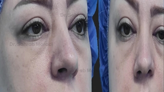 رأب الجفن العلوی والسفلی