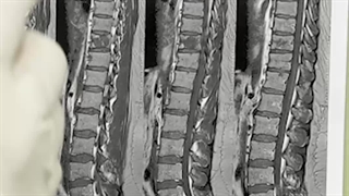 جراحی آقای جوان ۳۵ ساله که دچار بی اختیاری ادراری و اختلال حرکتی شده بودند