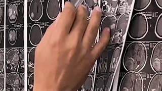 جراحی نتیجه بخش تومور مغزی بزرگ خانم ۴۰ ساله