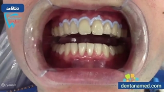 خرید رزین محافظ لثه Nova +Dam