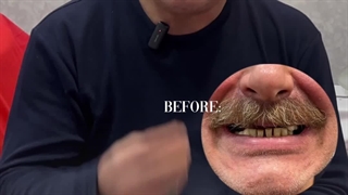 تجربه کاشت دندان مصنوعی فوری