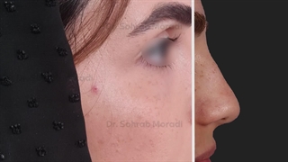 تجمیل الأنف فی إیران