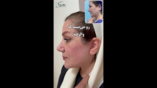 قبل و بعد یه نفره واقعا؟ - رضایت زیباجو از جراحی لیفت صورت