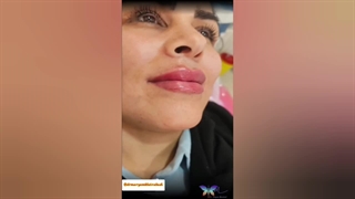 نمونه‌ای از تزریق فیلر لب (7)