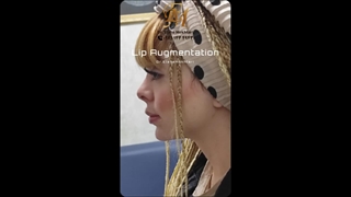 تزریق ژل لب