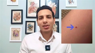 خال های قرمز رو از بدنت پاک کن! ارتباطش با کبد ؟!