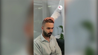 پاسخ کامل به سوالات شما درباره کاشت و تراکم مو