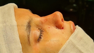 تجمیل الأنف - أفضل جراح أنف فی طهران