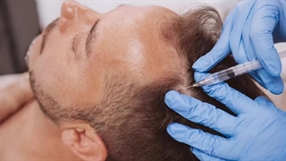 پی‌آرپی مو، روشی عالی برای تقویت و رشد موها