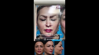 عمل زیبایی بینی به همراه بلفاروپلاستی پلک