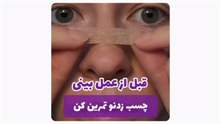 نحوه صحیح چسب زدن بینی بعد از عمل | راهنمای گام‌به‌گام برای نتایج بهتر