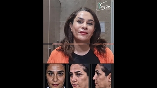 رفع الحاجب بالمنظار - أفضل جراح تجمیل