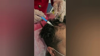 مزوتراپی سکه ای (ریزش سکه ای مو)