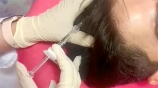 درمان ریزش مو کرمان