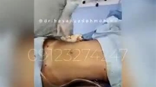 لیپو ویزر شکم پهلو و تزریق باسن لمینت