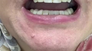 فیلم گذاشتن دندان مصنوعی پارسیل فلکسی تکه ای