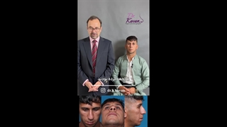 جراحی بینی مردانه توسط دکتر کاوان