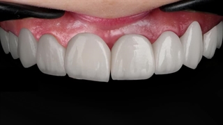 اصلاح خط لبخند