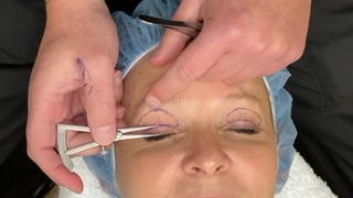 عمل پلک بدون بخیه